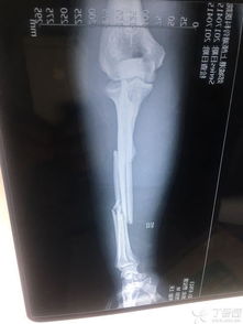 尺橈開放骨折的功能重建與修復(fù)策略 結(jié)合醫(yī)學(xué)倫理與臨床特征的解析